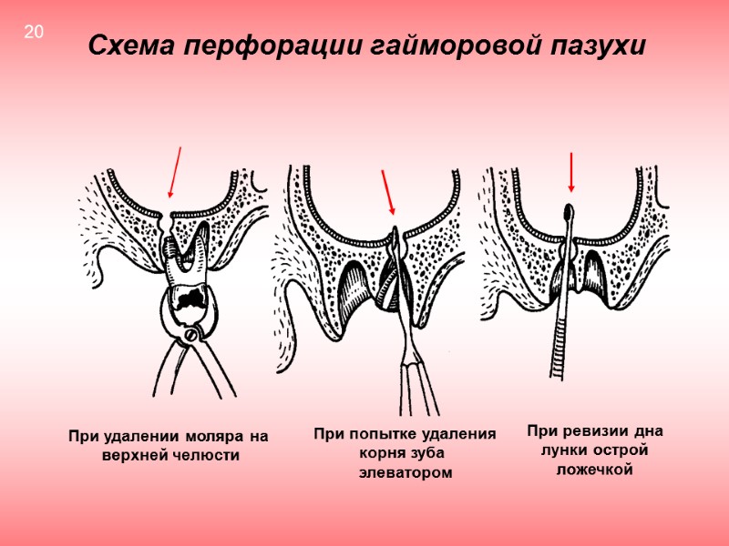 Схема перфорации гайморовой пазухи При удалении моляра на  верхней челюсти При попытке удаления